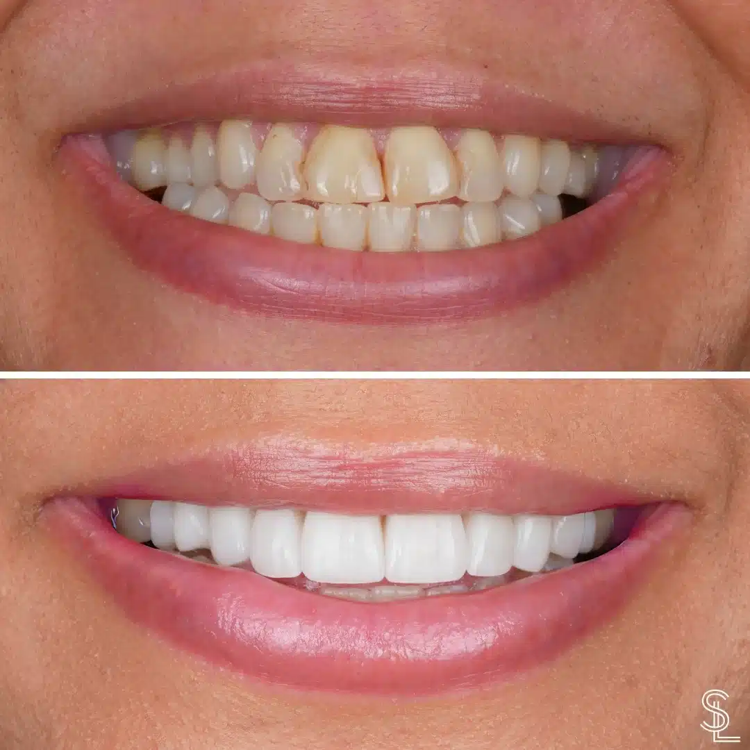 Smile Lounge Desiree patient teeth whitening treatment Before After Image