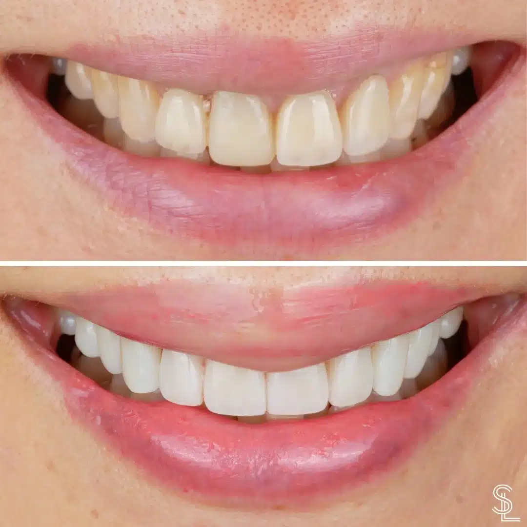 Dentures Before and After