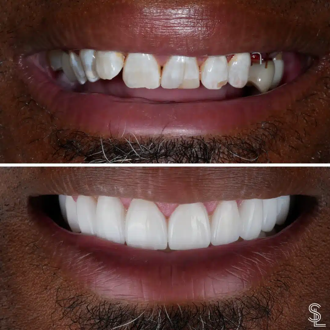 Smile Lounge Kurt patient teeth replacement treatment Before After Image