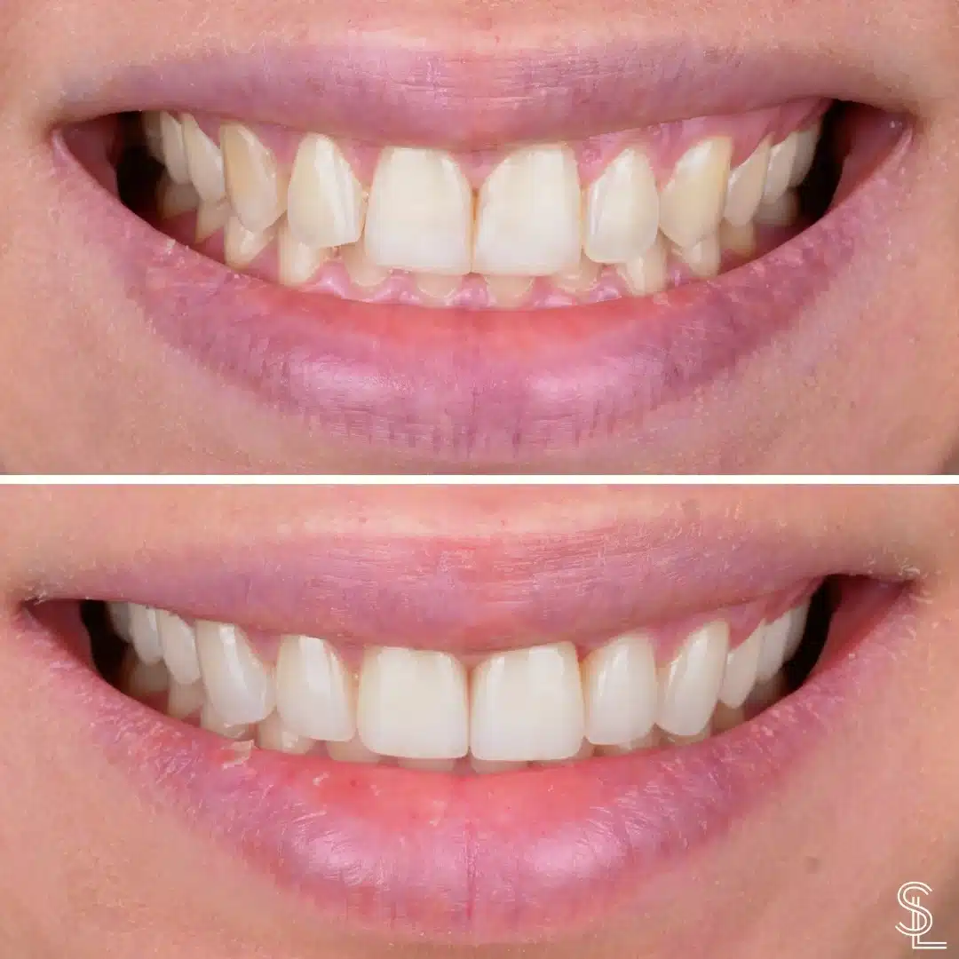 Smile Lounge Lopez Luego teeth whitening treatment Before After Image
