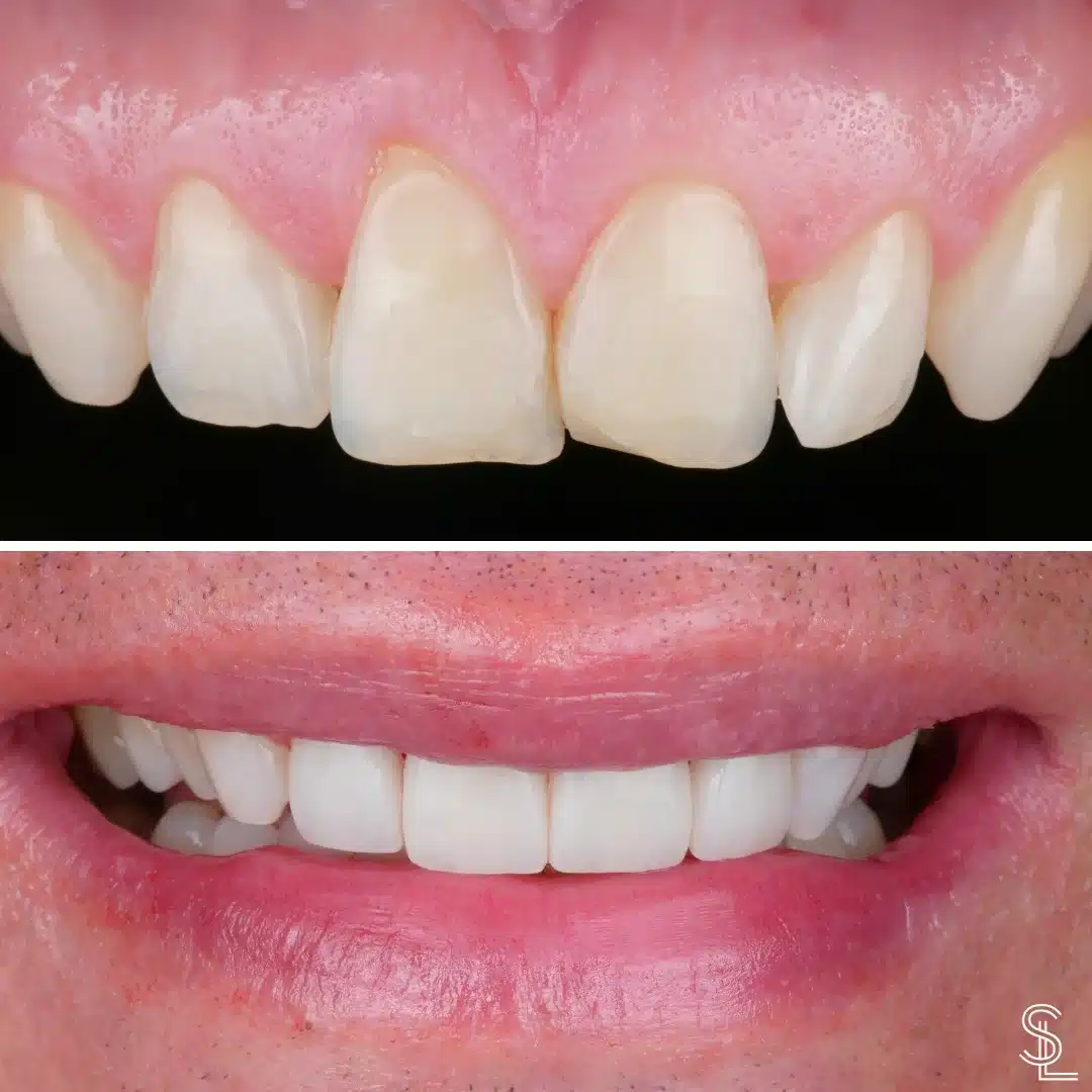 Smile Lounge Miguel patient teeth whitening treatment Before After Image