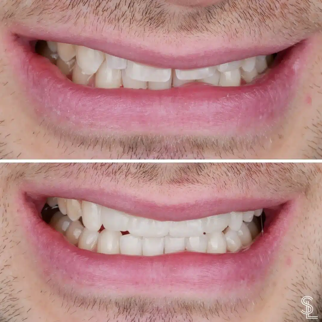 Smile Lounge Ok Hee patient veveers treatment Before After Image