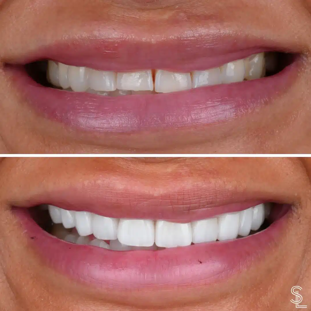 Teeth Whitening Before and After
