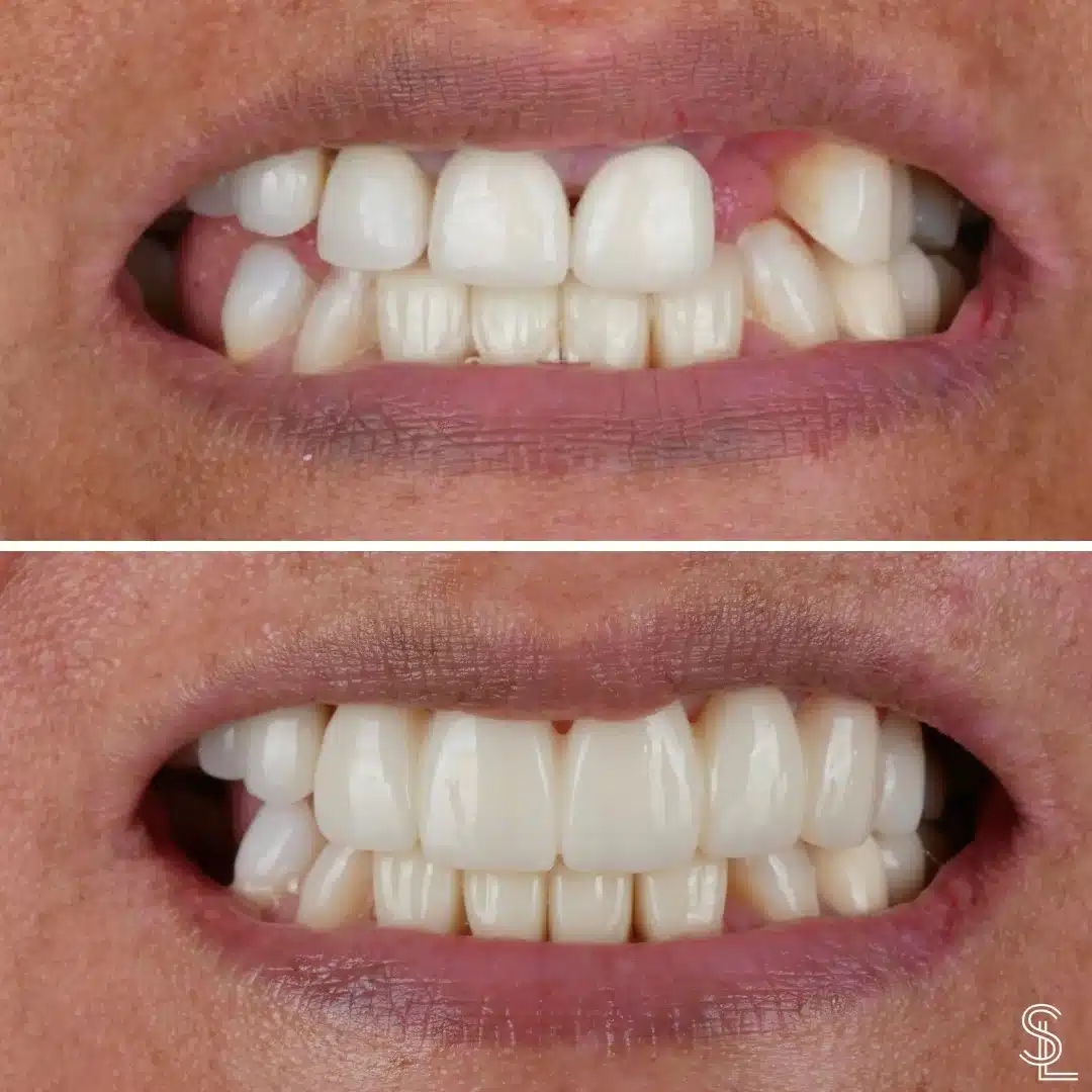 Smile Lounge cosmetic dentistry procedure Before After Image