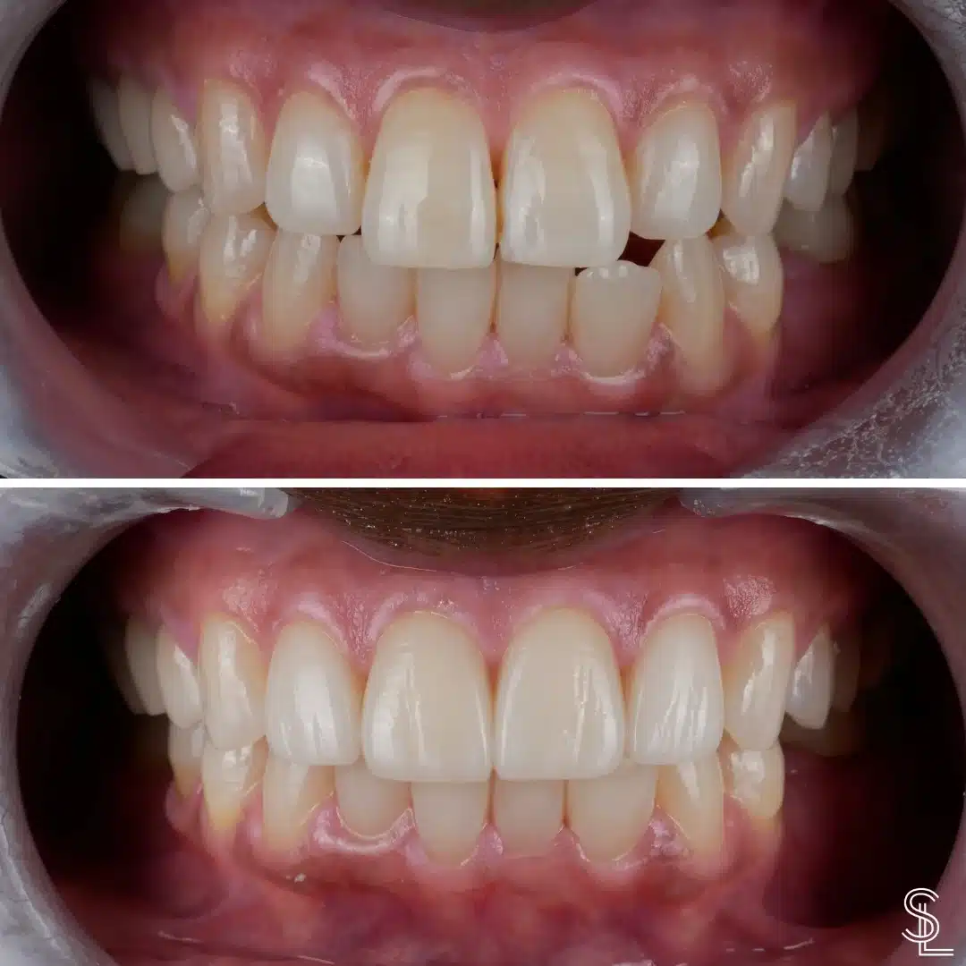 Smile Lounge cosmetic dentistry procedure Teeth Whitening Before After Image