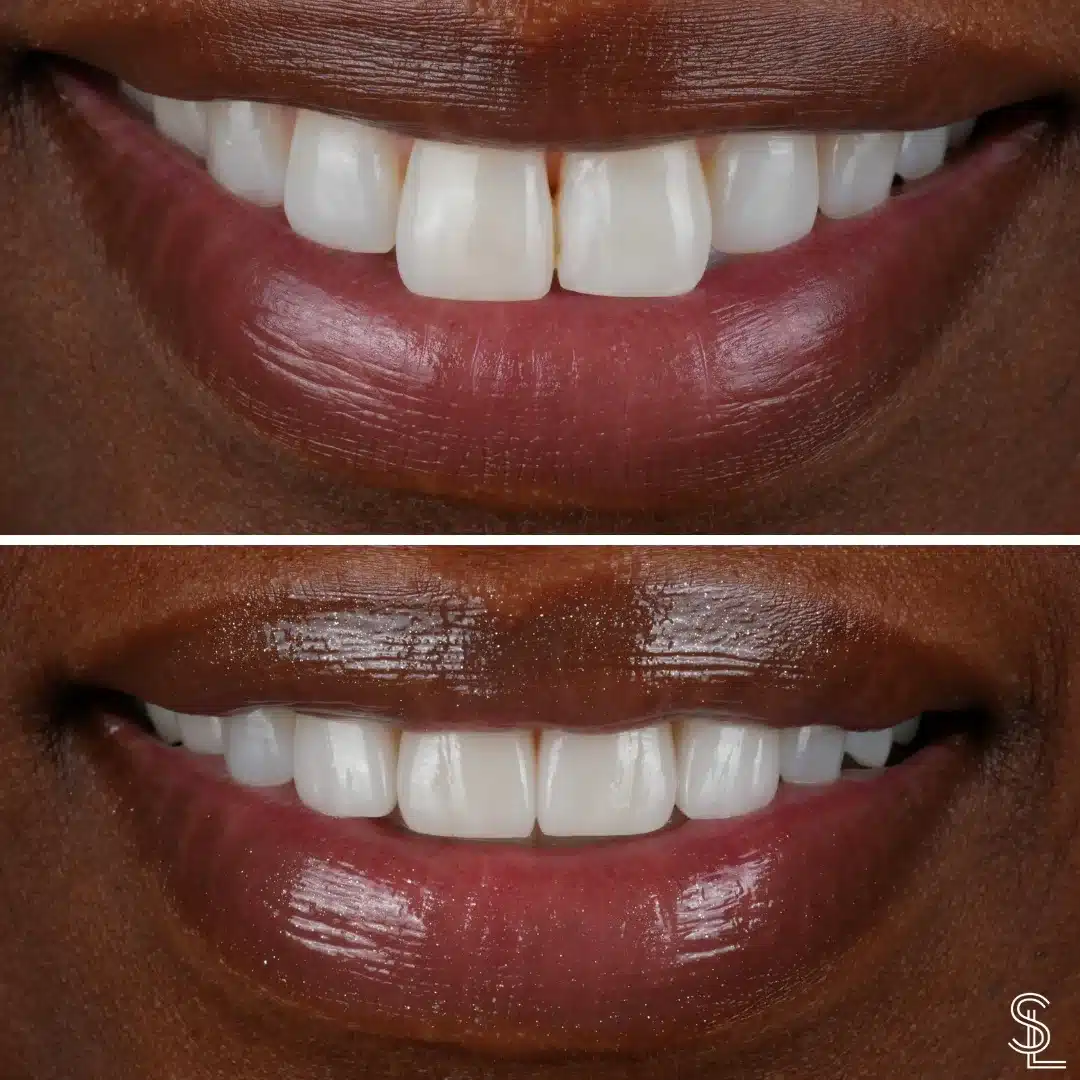 Teeth Whitening for Beautiful Smile Before and After