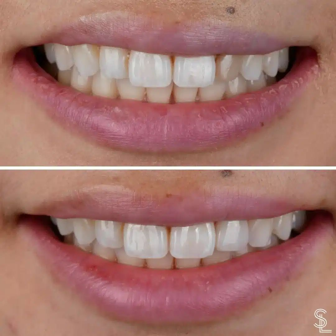 Smile Lounge cosmetic dentistry teeth whitening treatment Before After Image
