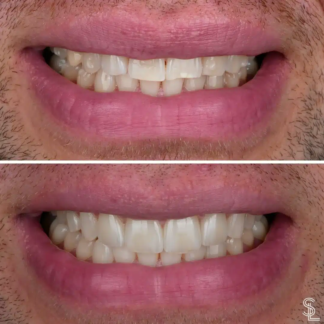 Smile Lounge dental veneers treatment Before After Image