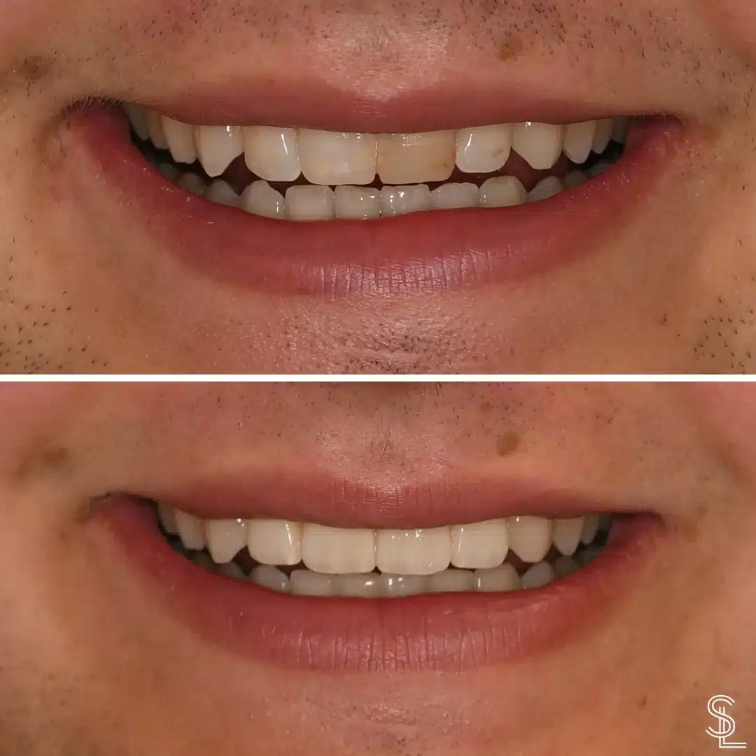 Smile Lounge pateitnt Jake Callahan Before After Image